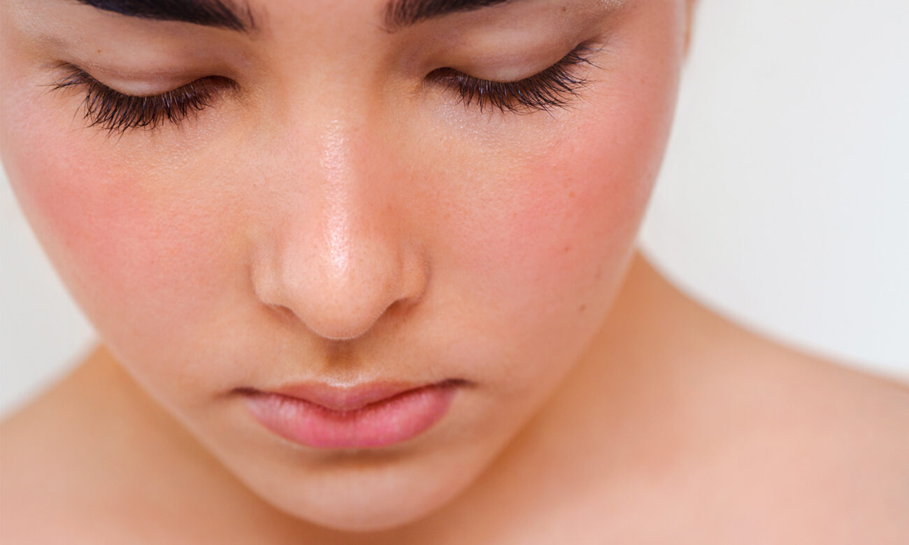 The Link Between Gut Health & Rosacea, From An Integrative Derm