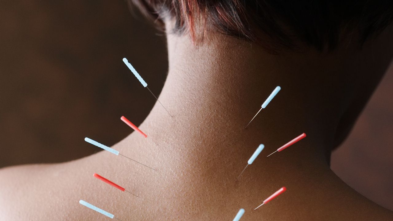 The many benefits of acupuncture, from pain to puffiness