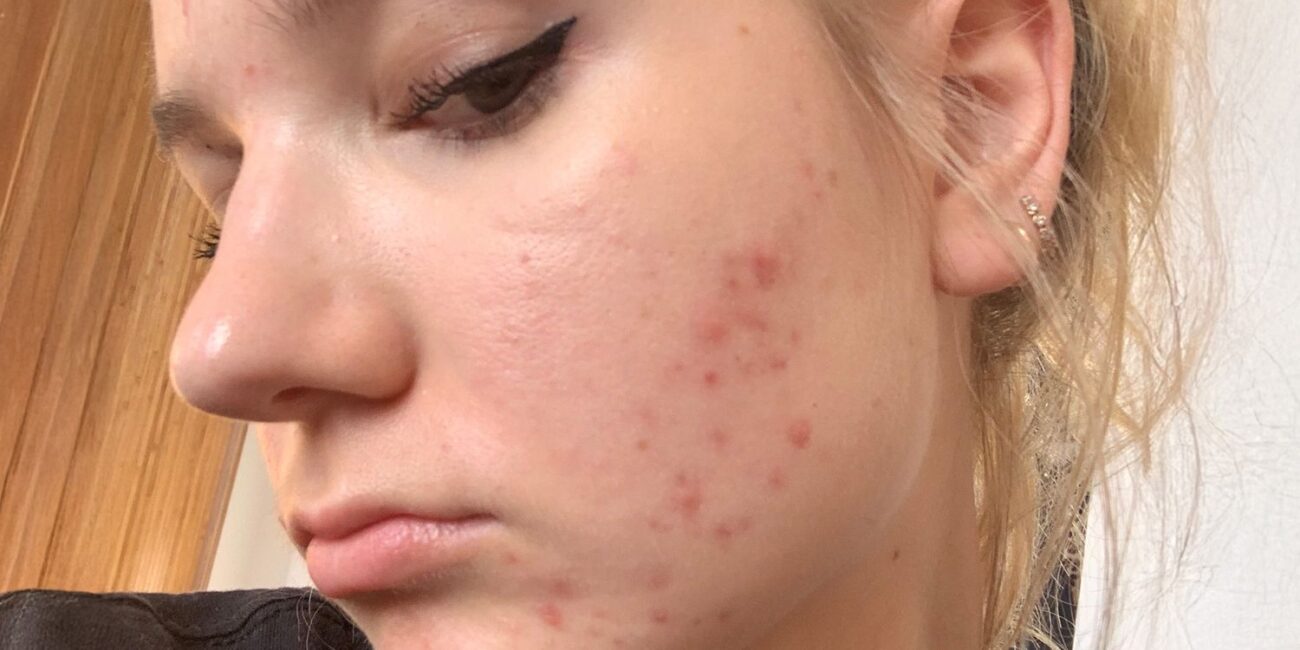 So, You Have Luteal Acne—How to Stop the Breakout Cycle